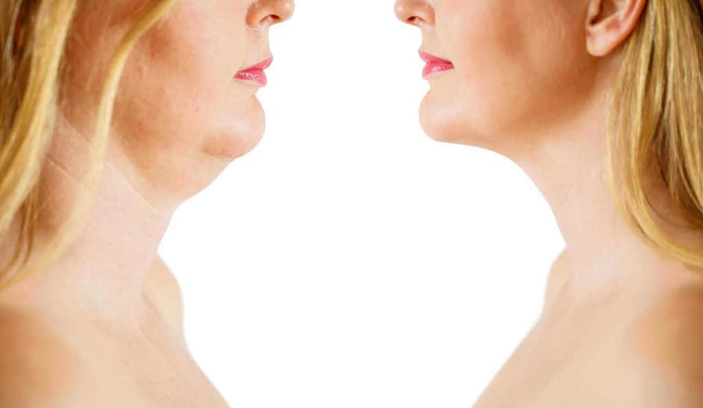 Double Chin treatment Ross-on-Wye before and after results