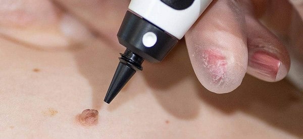 After Skin Tag Removal Ross-on-Wye