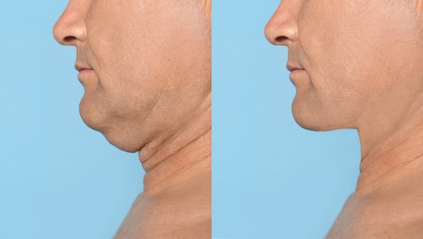 Which Non-Surgical Treatments Work Best for Jowls and Loose Skin Ross-on-Wye?