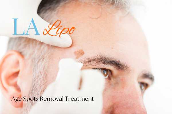 What Are the Most Effective Treatments for Age Spots Ross-on-Wye?
