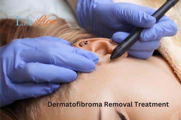 Dermatofibroma Removal Treatment Ross-on-Wye