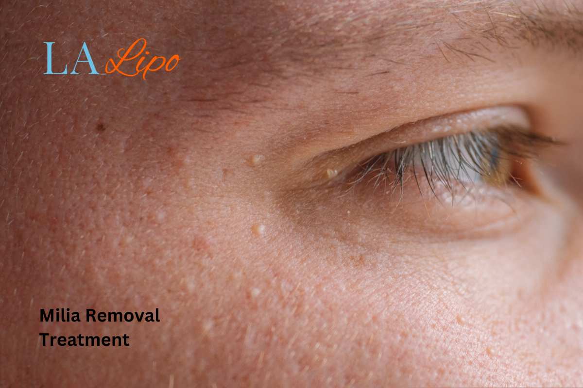 Cryopen Milia Removal: Is It the Easiest and Safest Option Ross-on-Wye?