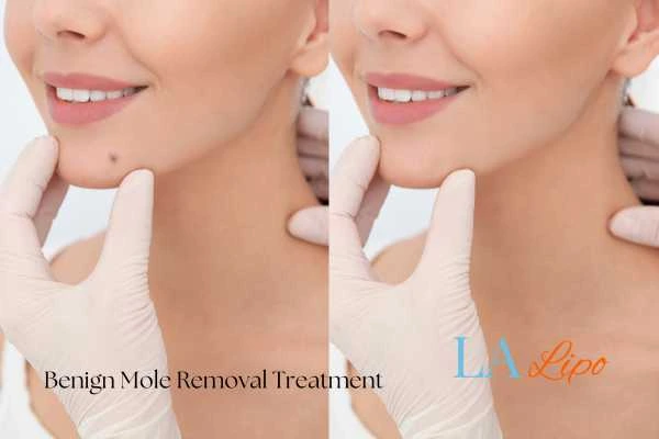 Before-and-after results following benign mole-removal treatment Ross-on-Wye