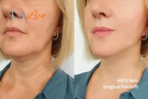 hi-fu for wrinkles Ross-on-Wye before and after results