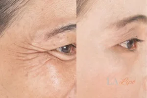 Before and after results of woman - HI-fu wrinkles reduction treatment Ross-on-Wye