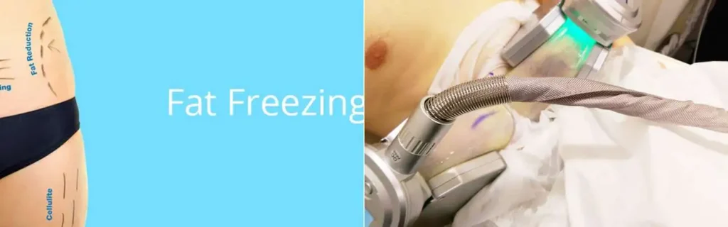 Fat freezing Ross-on-Wye on multiple areas of the body