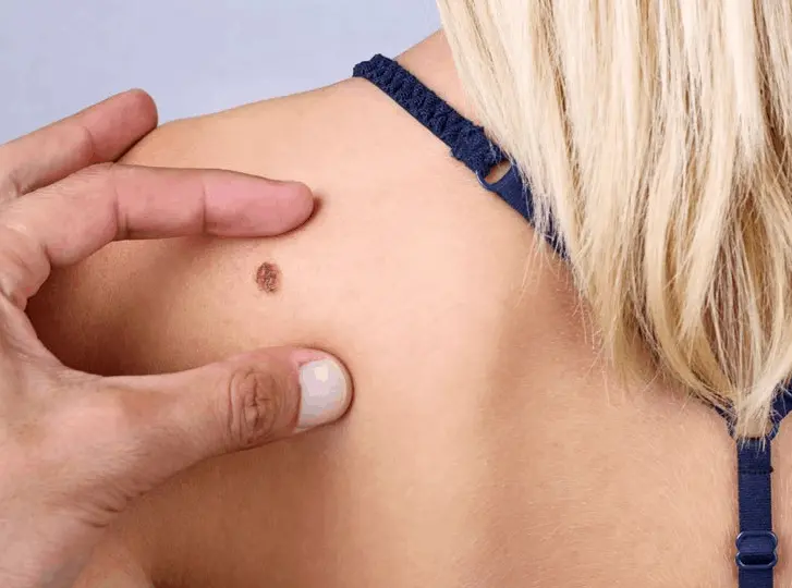 woman having mole removal Ross-on-Wye consultation before treatment.