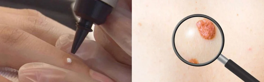 CryoPen practitioner Ross-on-Wye assessing a benign mole before treatment