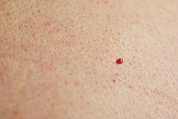 close up of a cherry angioma Ross-on-Wye