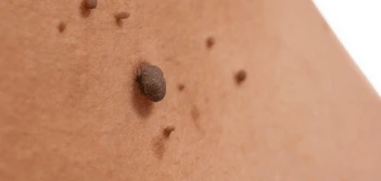 image of a skin tag Ross-on-Wye