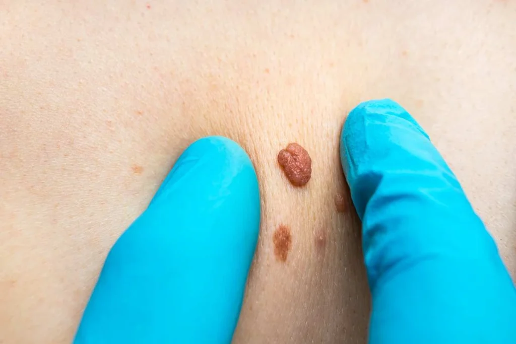 Consultant examining a skin tag Ross-on-Wye