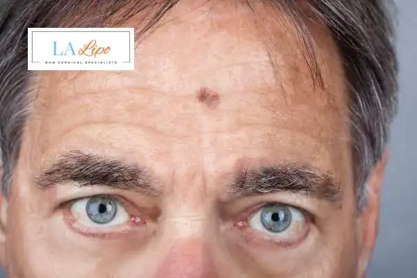 Solar Lentigo Removal Ross-on-Wye image of man with mark on his forehead