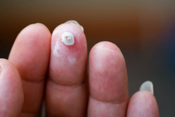 wart on person finger - cryotherapy to treat from LA LIPO Ross-on-Wye