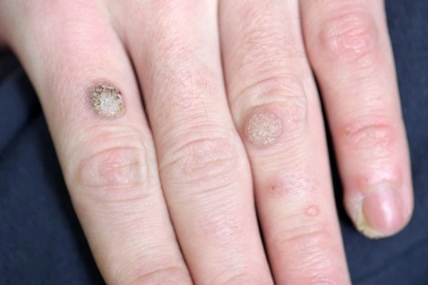 photo of warts on person hand - see wart removal Ross-on-Wye from LA LIPO