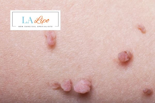 Does cryopen skin tag removal Ross-on-Wye hurt? Find out now call our team today!