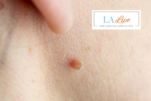 Book skin tag removal Ross-on-Wye today speak to our team now!