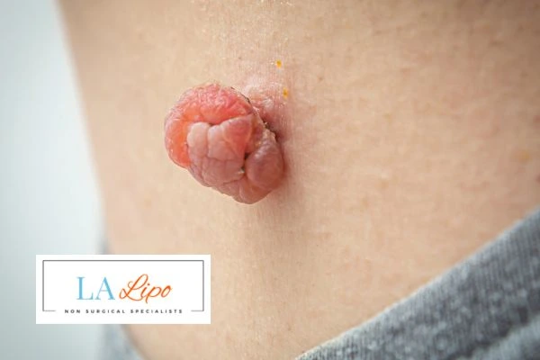 Interested in skin tag removal Ross-on-Wye? Concerned about the pain? Find out more today!