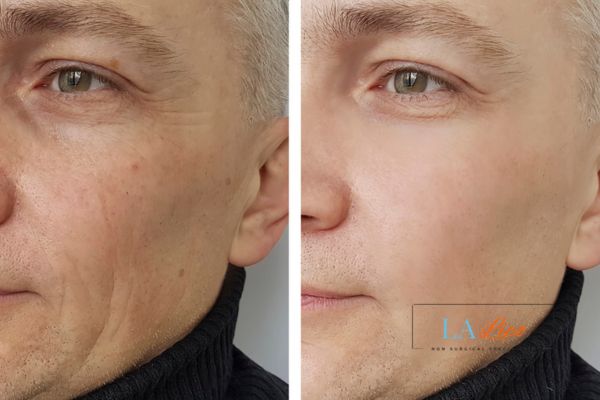 See the amazing results of Morpheus8 Treatment Ross-on-Wye!