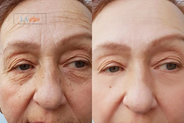 The powerful benefits of Morpheus8 Treatment Ross-on-Wye - Call Our team today!