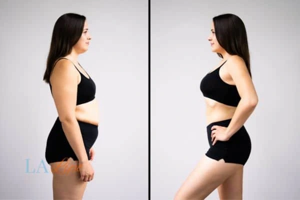 Picture of womans before and after using LA-EMS body sculpting to improve her core strength Ross-on-Wye