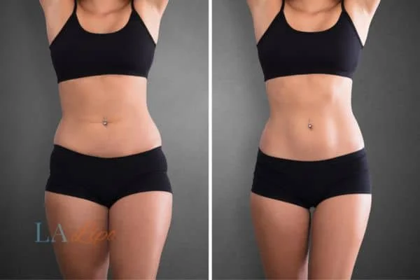 before and after results of non-surgical treatment to help a woman's body image and mental health Ross-on-Wye