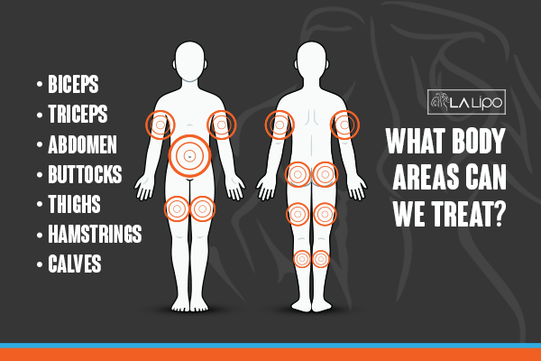 Diagram to show areas you can have LA-EMS Body Sculpting Treatment Ross-on-Wye