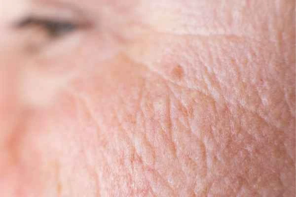 close up picture of a woman's face showing an age spot Ross-on-Wye