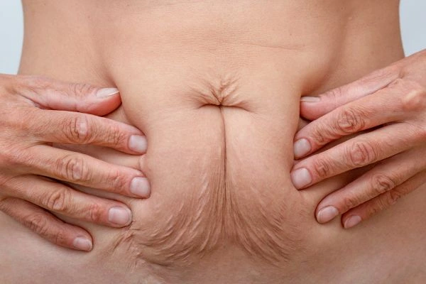 Image of a woman's stomach with loose skin - example of skin tightening Ross-on-Wye options