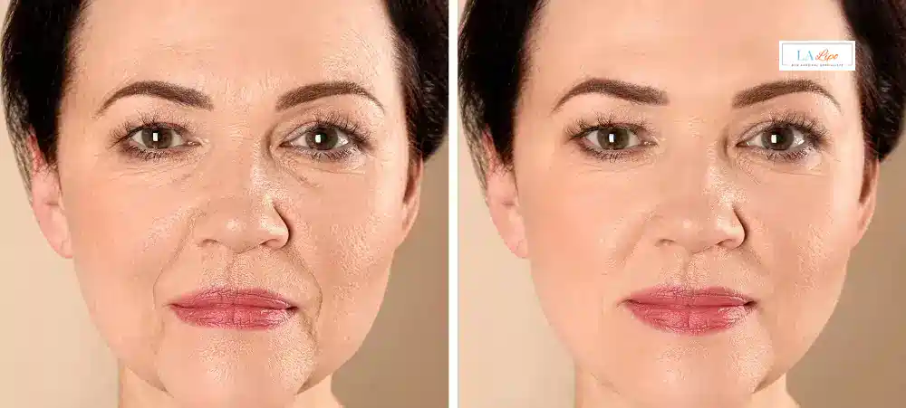 How Long Does It Take to See Results and How Long Do They Last Ross-on-Wye?