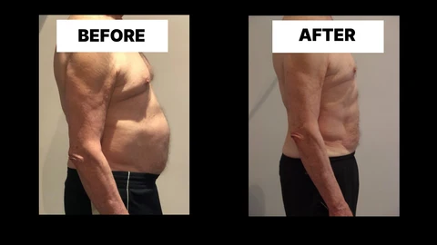 What Symptoms Can Diastasis Recti Cause in Men? Weak Core, Back Pain and Poor Posture Ross-on-Wye